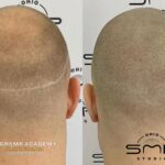Scalp Micropigmentation
