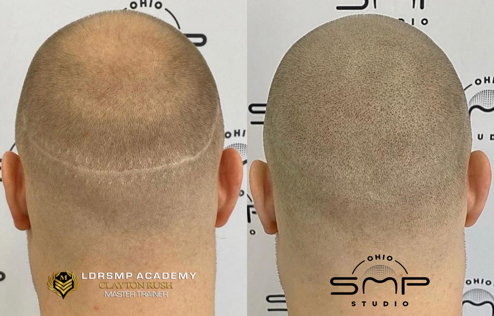 Scalp Micropigmentation